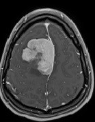 MRI image of brain tumour